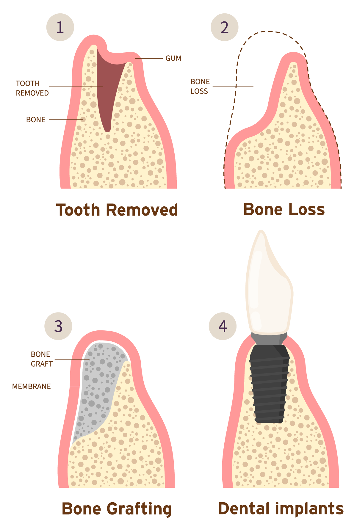 Everett Bone Grafting