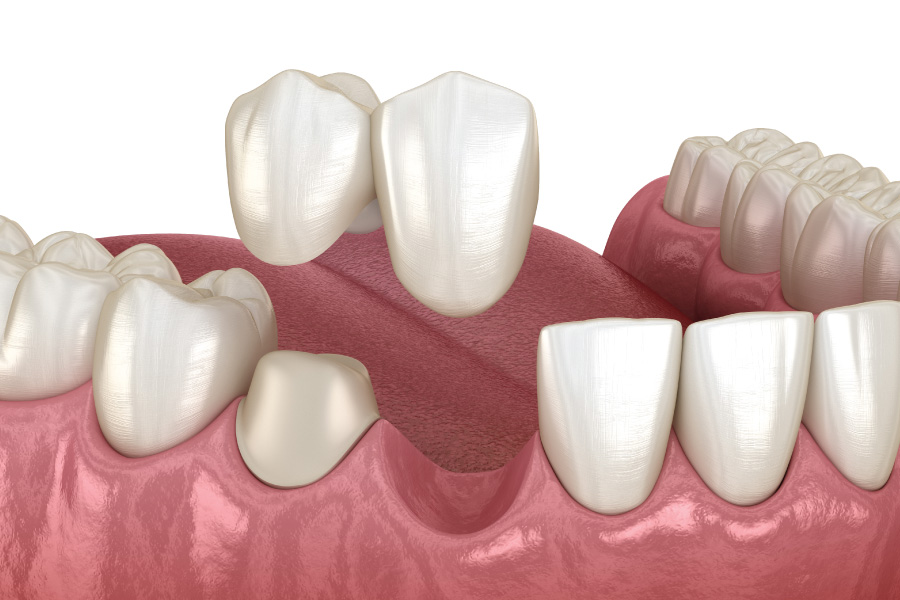 Everett Cantilever Bridges