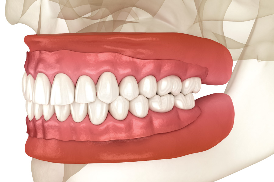 Everett Full Dentures