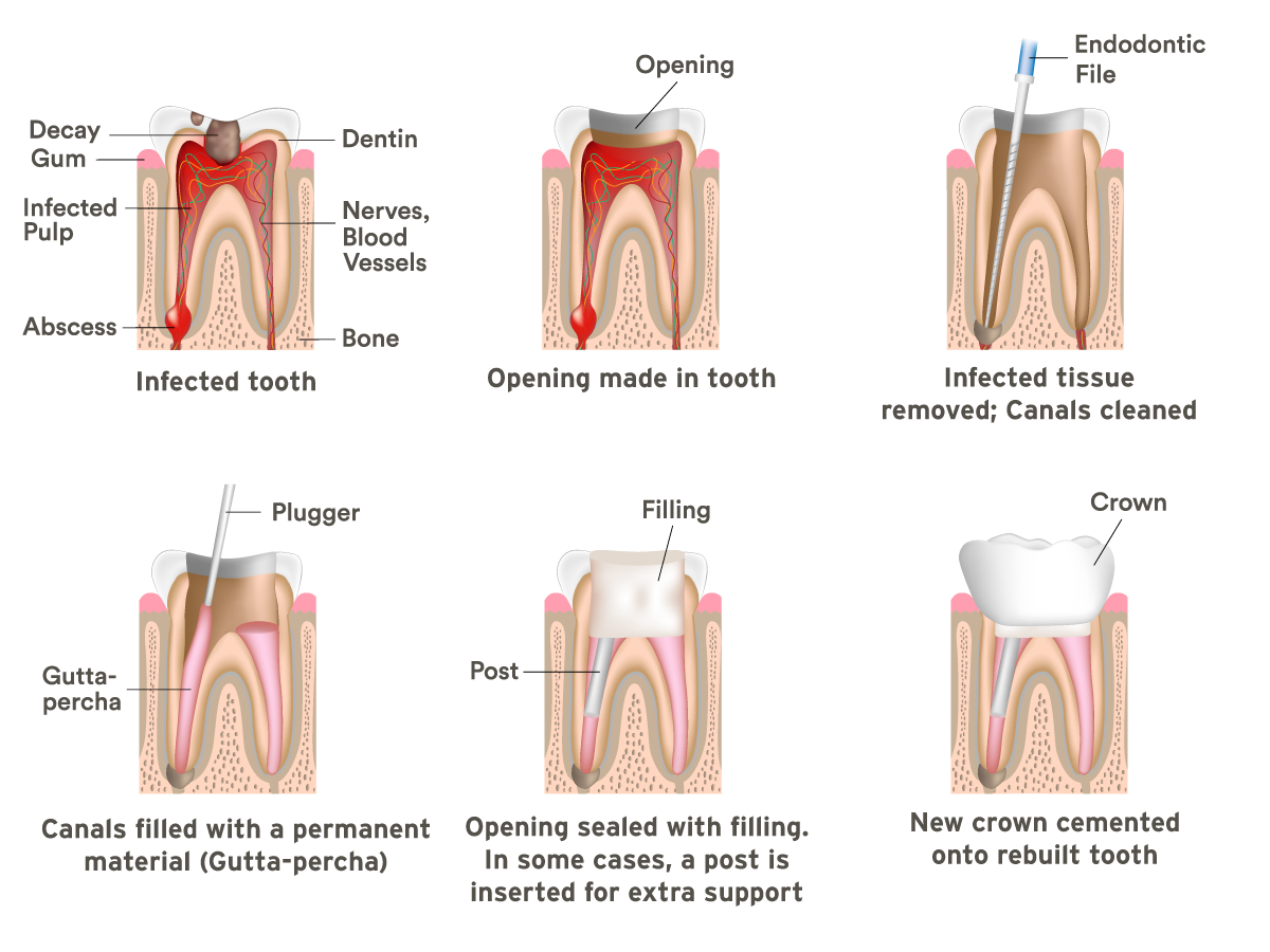 Everett Root Canals