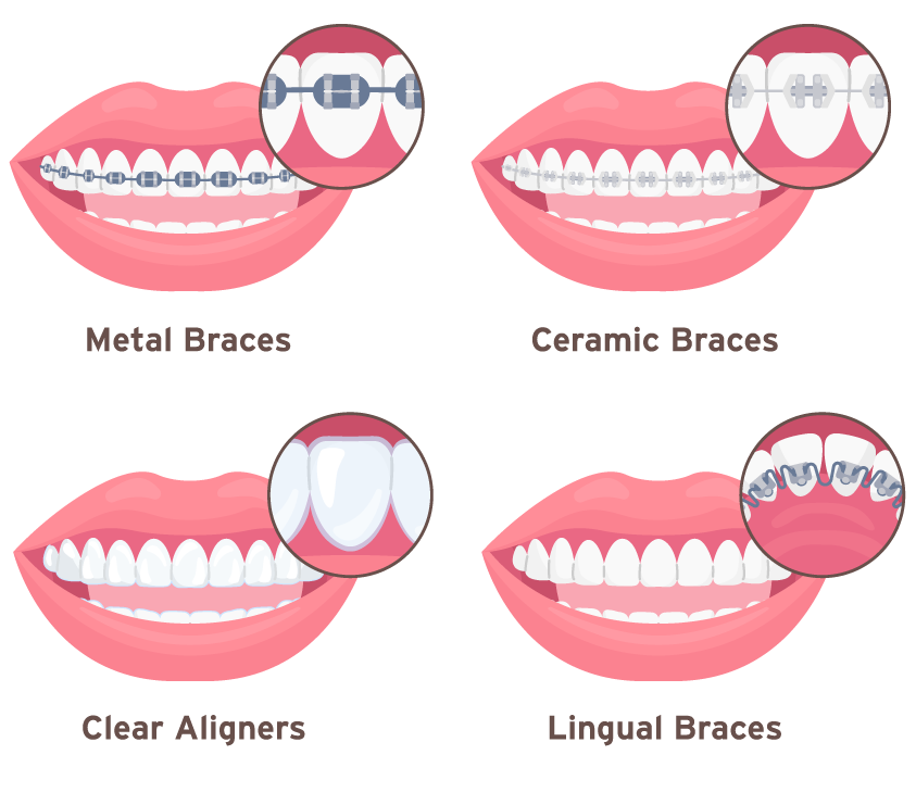 Types of Braces